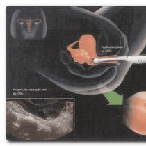 Рекомендации после переноса эмбрионов при эко